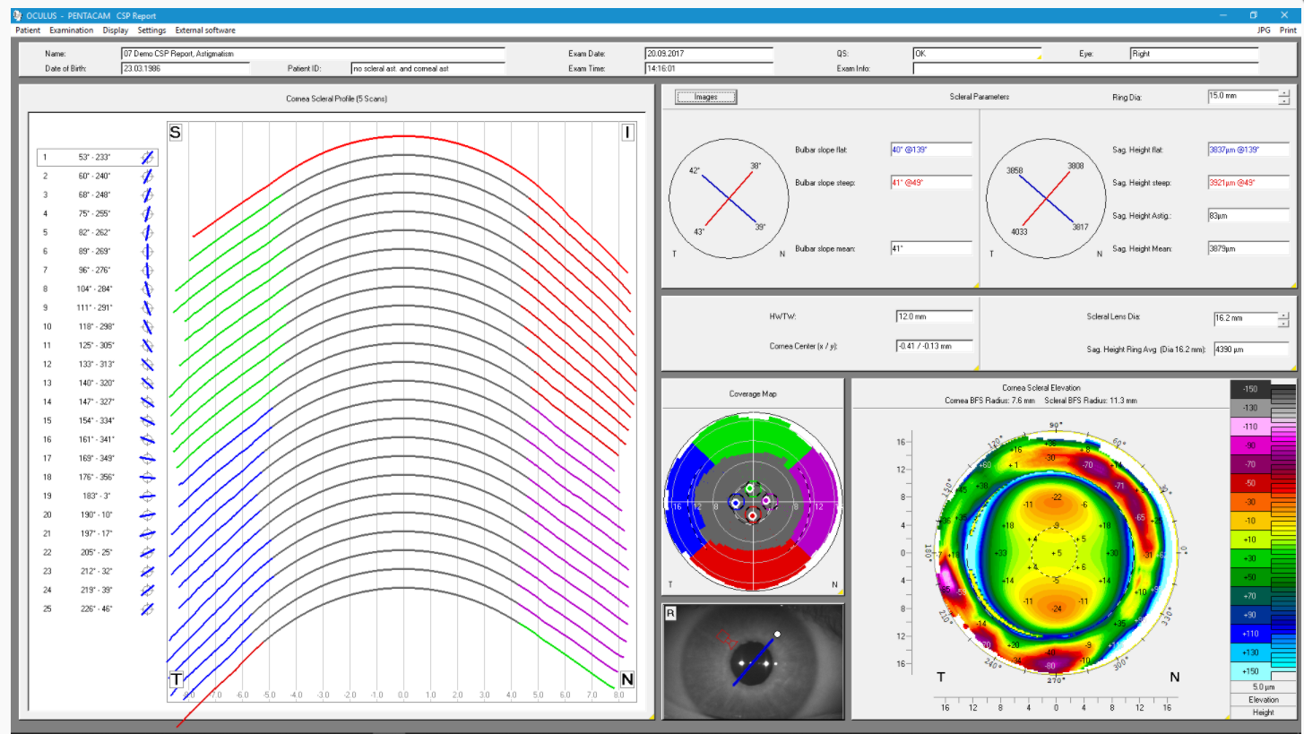 Figure 1. Oculus Pentacam CSP (corneal scleral profile) aids in scleral lens design