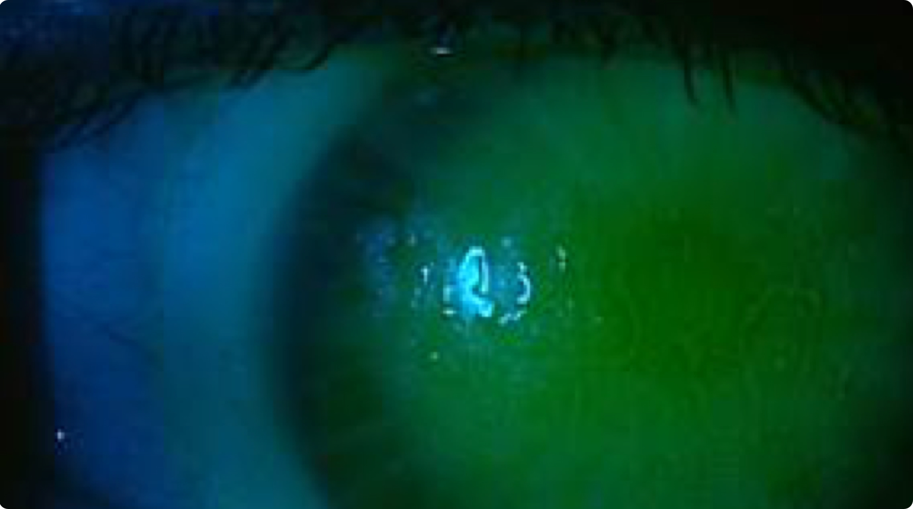 Scleral Lenses Fogging