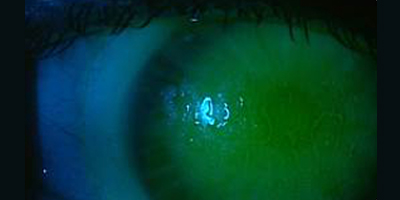 Scleral Lenses: Fogging Issues With Easy Solutions
